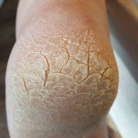 MA ROUTINE SOS TALONS FISSURÉS